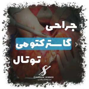 جراحی گاسترکتومی توتال