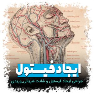 جراحی ایجاد فیستول و شانت شریانی_وریدی