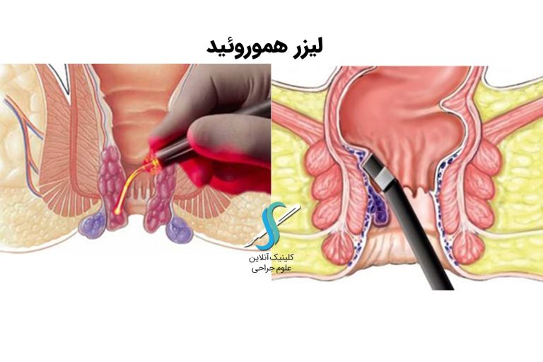 لیزر بواسیر در اصفهان