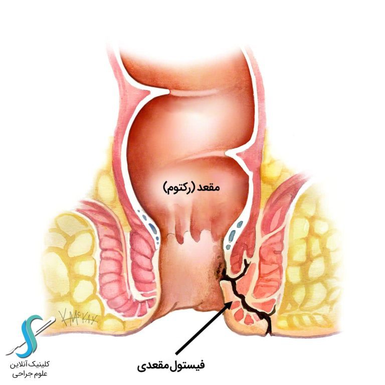 لیزر درمانی فیستول