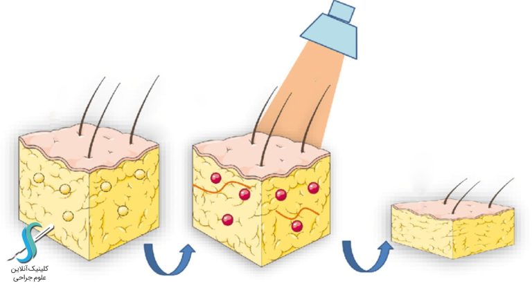 لیزر درمانی چاقی