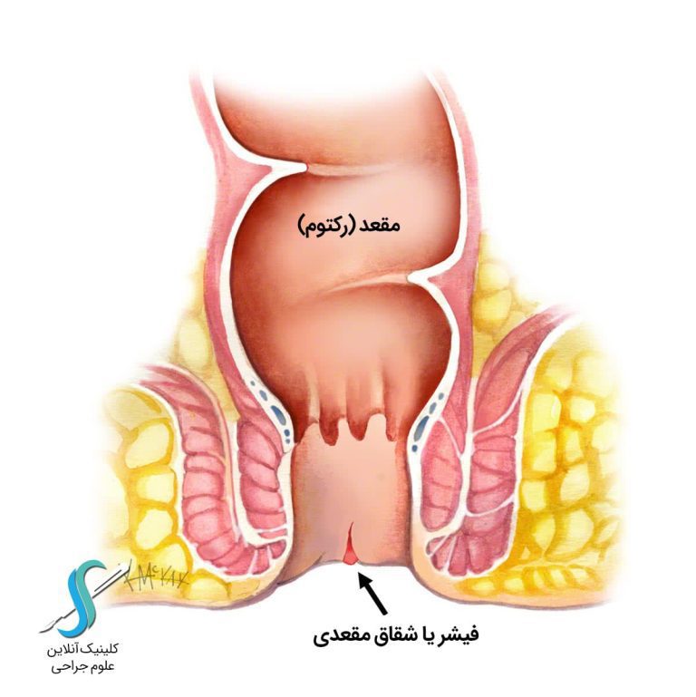 لیزر شقاق در اصفهان