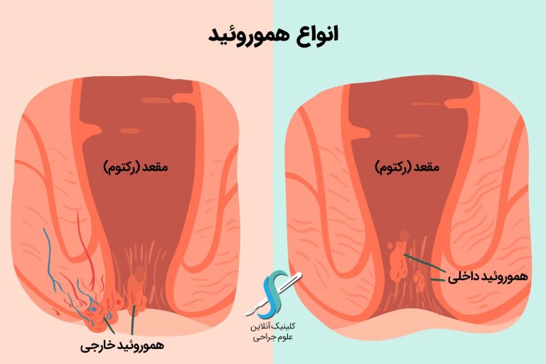 لیزر هموروئید در اصفهان