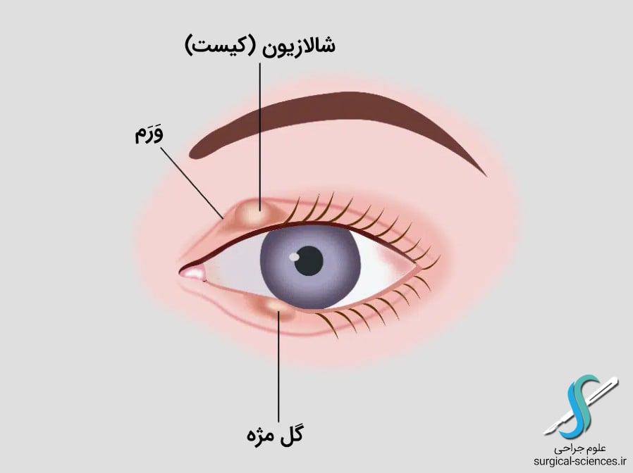 تفاوت شالازیون با گل مژه