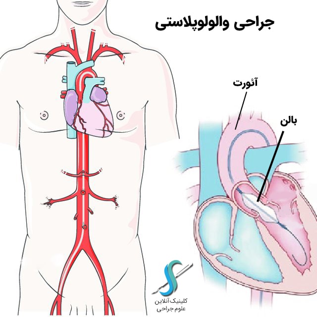 عمل والولوپلاستی