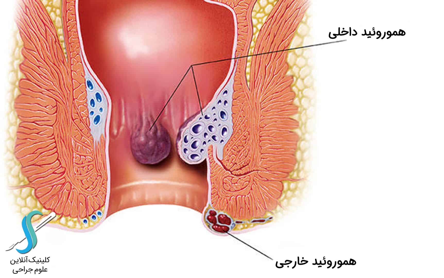 بواسیر داخلی و بواسیر خارجی