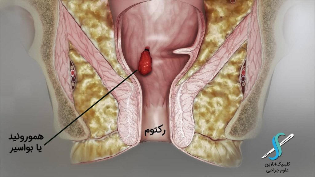 بواسیر چیست؟