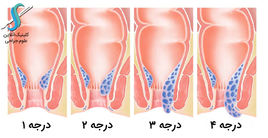 درجه بندی بواسیر یا هموروئید