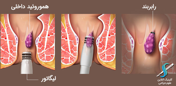 درمان هموروئید با رابربند