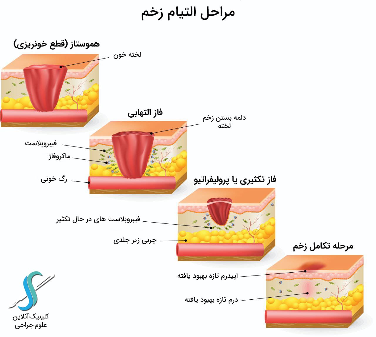 مراحل التیام زخم