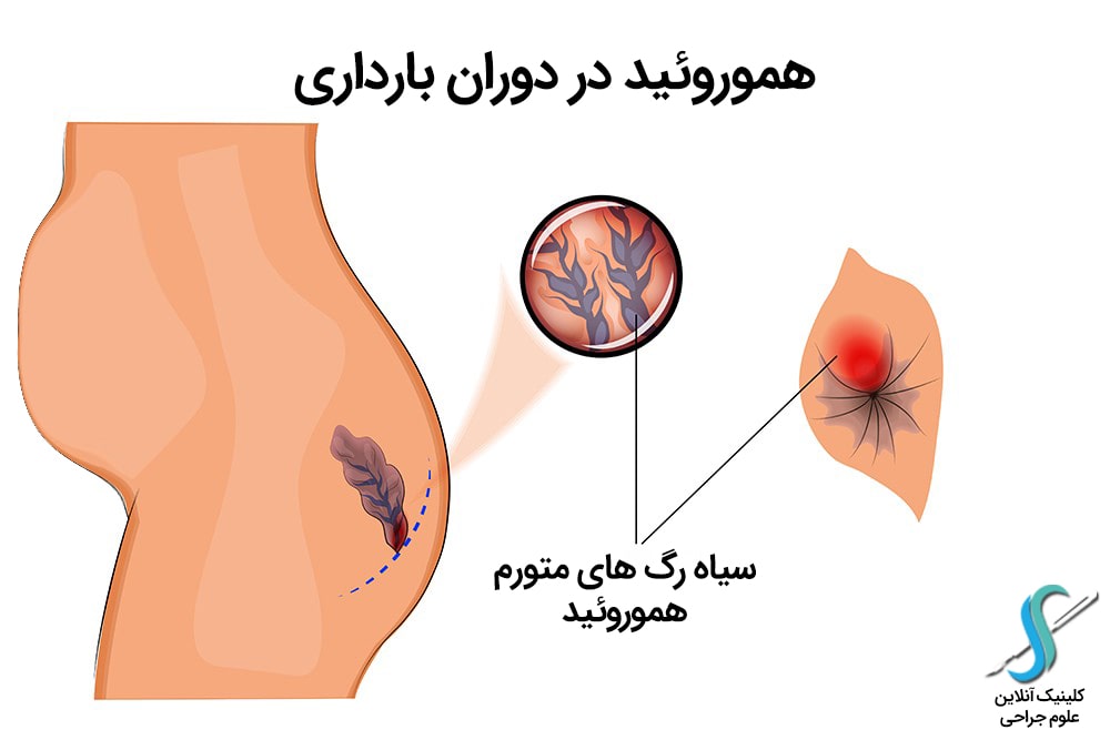 عکس بواسیر در بارداری