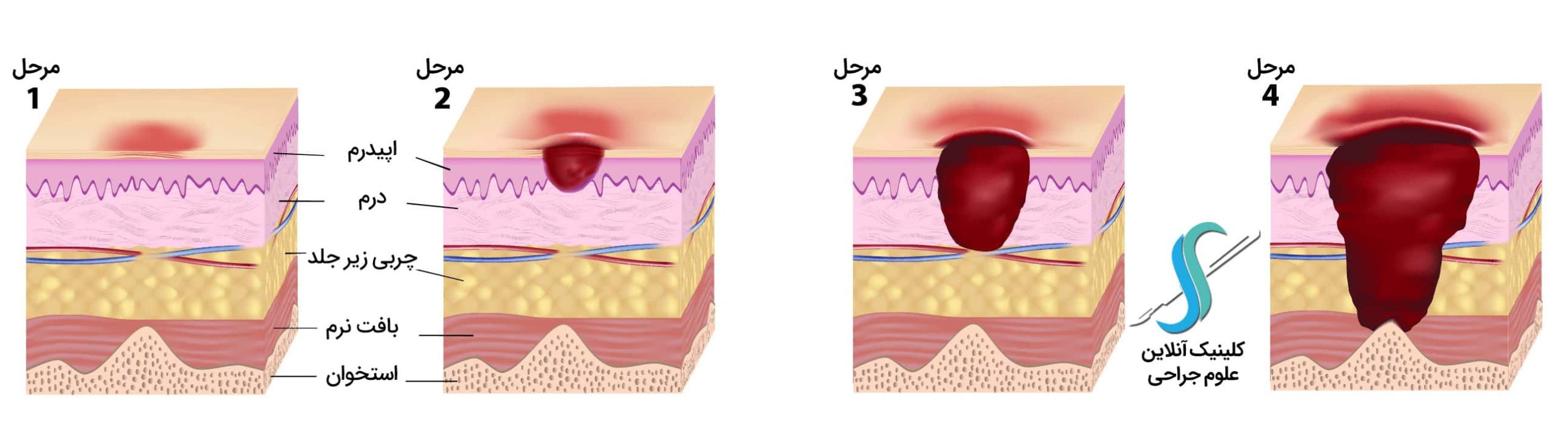 مراحل زخم بستر