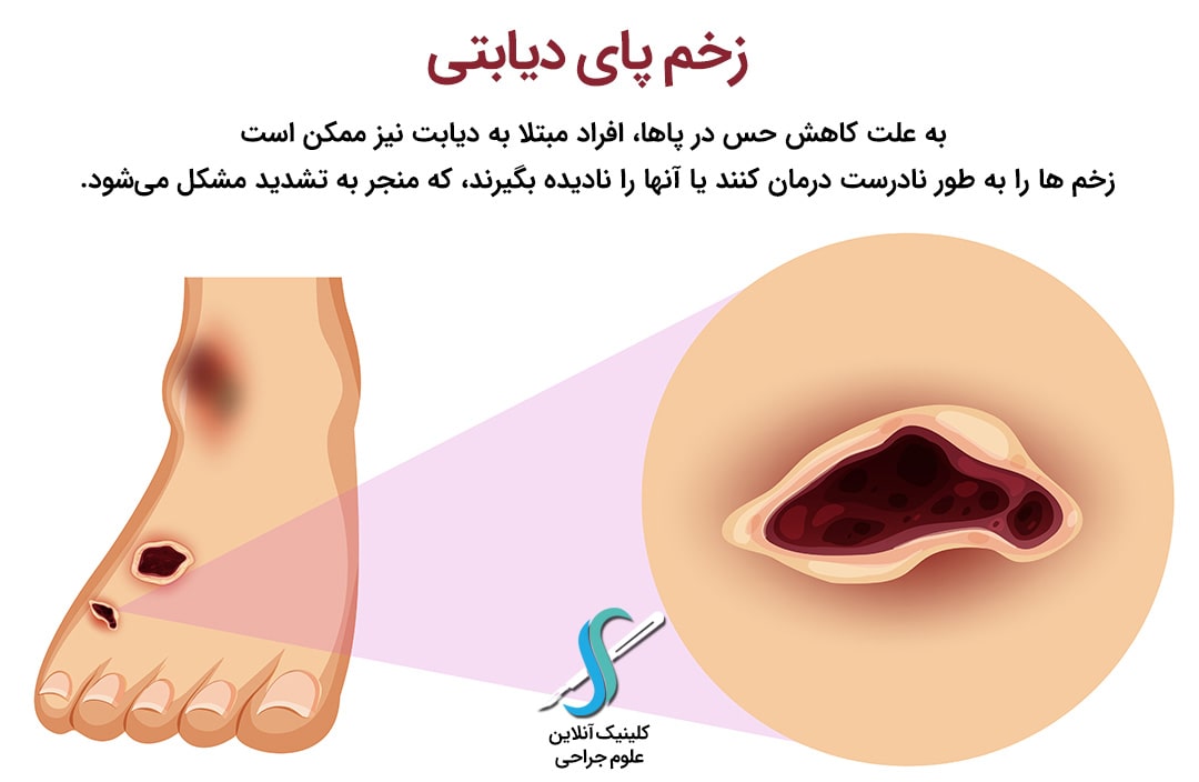 زخم پای دیابتی