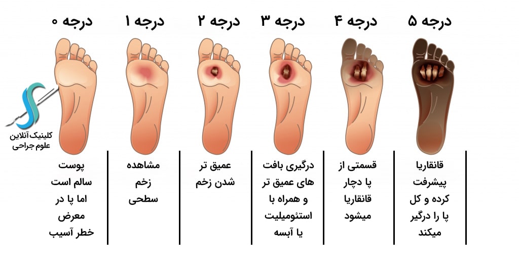 علائم زخم دیابتی