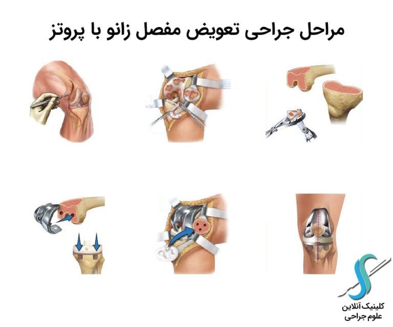 مراحل جراحی تعویض مفصل زانو با پروتز