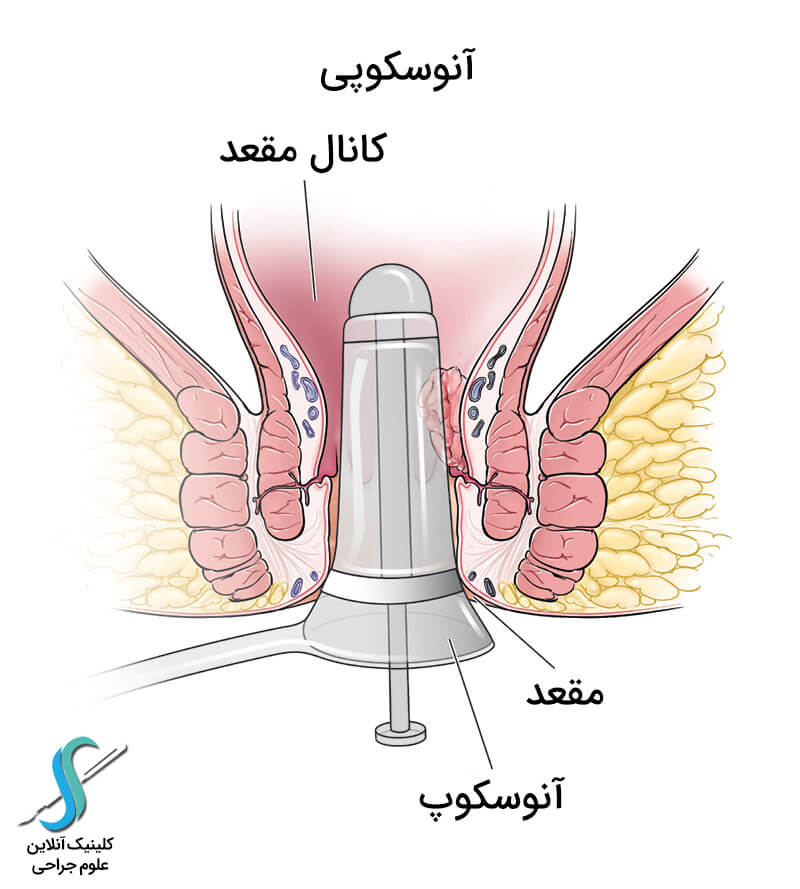 عوارض و علائم شقاق مقعدی