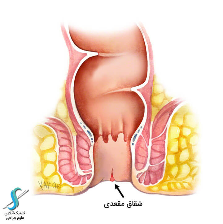 علائم شقاق چیست؟