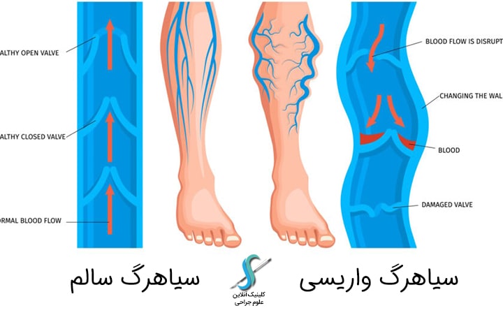 تشخیص بیماری واریس