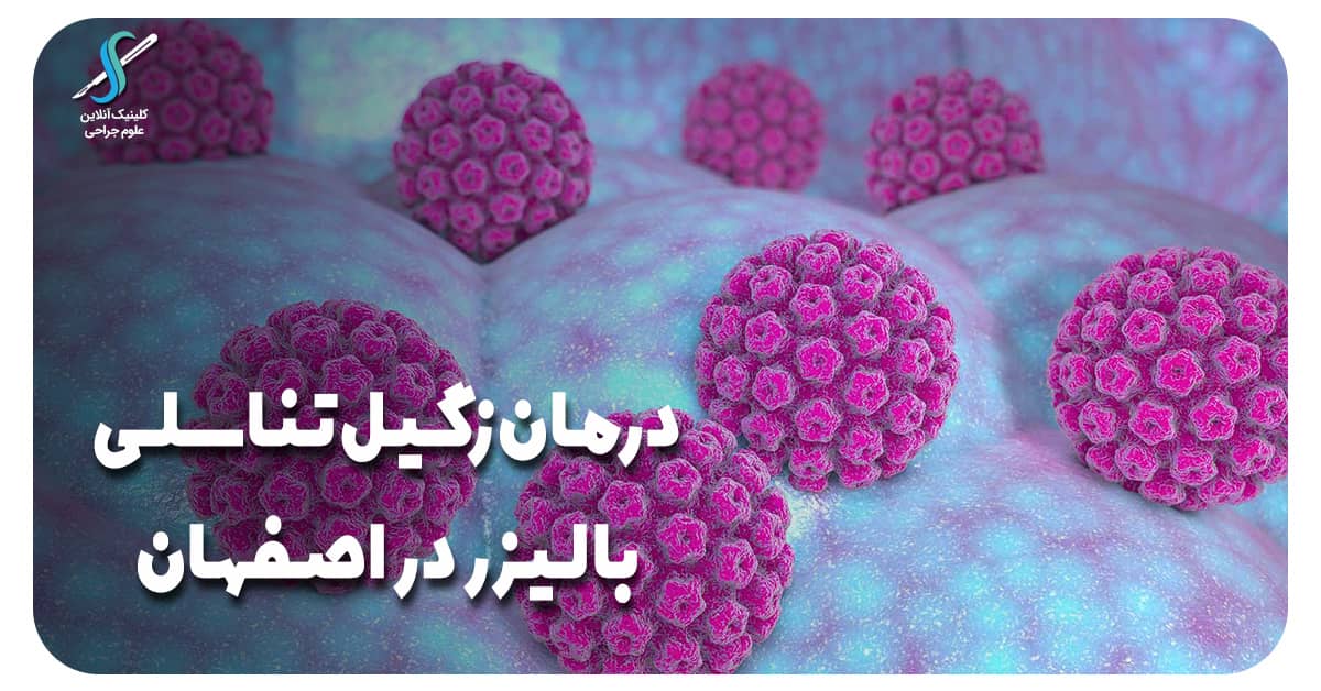 درمان زگیل تناسلی با لیزر در اصفهان با بهترین متخصصان