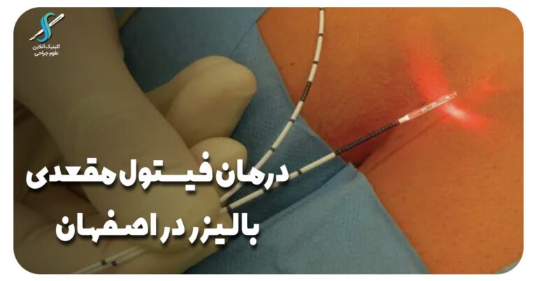 درمان فیستول مقعدی با لیزر در اصفهان