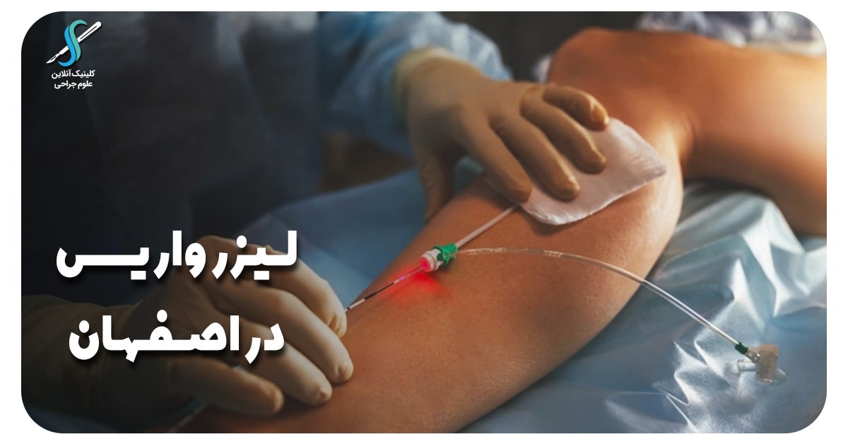 لیزر واریس در اصفهان با پیشرفته ترین متد درمانی