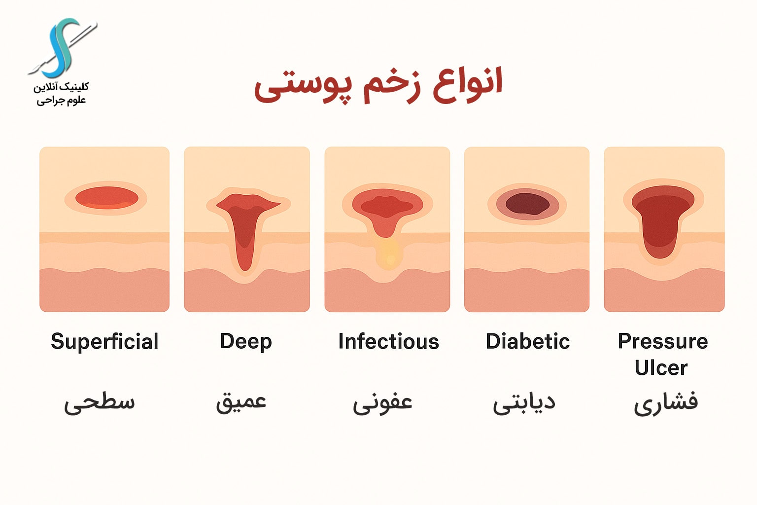 تصویر آموزشی انواع زخم پوستی شامل زخم سطحی، عمیق، عفونی و دیابتی