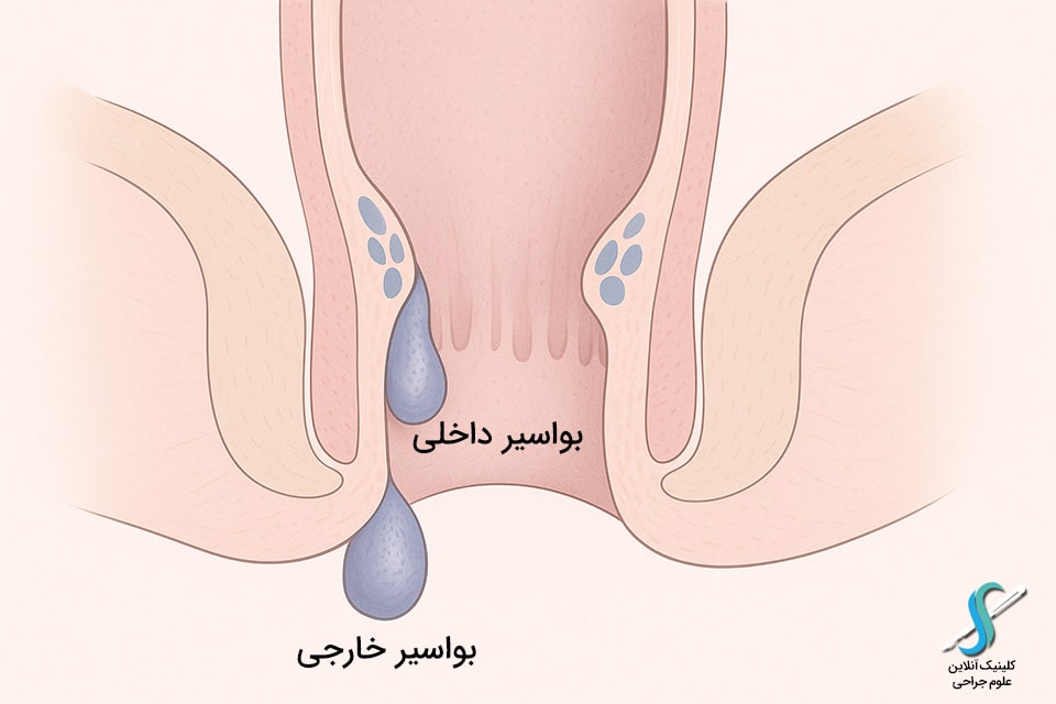 تصویر شماتیک مقایسه بواسیر داخلی و خارجی